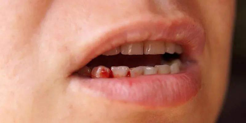 Giấc mộng gãy răng bị chảy máu chứng tỏ sức khoẻ của bạn đang không ổn